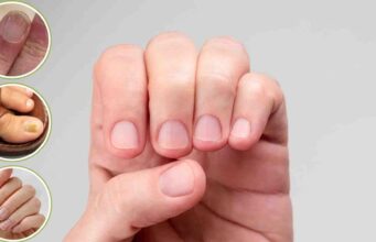 क्या आपके नाखून भी हो रहे हैं पीले या नीले? जानें शरीर में छिपी किन बीमारियों की ओर है यह इशारा