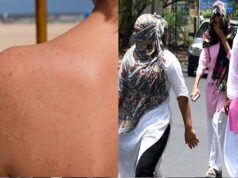 भीषण गर्मी का असर, सनबर्न के मरीज बढ़े; त्वचा में जलन और धब्बों की शिकायतें